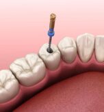 Root Canal Treatment