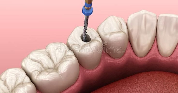 Root Canal Treatment