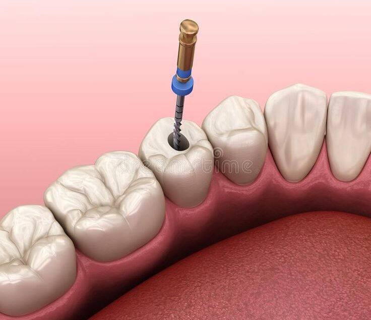 Root Canal Treatment