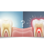 Tooth Sensitivity After Fillings: Normal or Warning Sign?