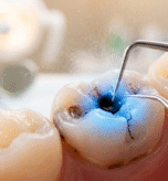 Why Does One Tooth Keep Getting Cavities?