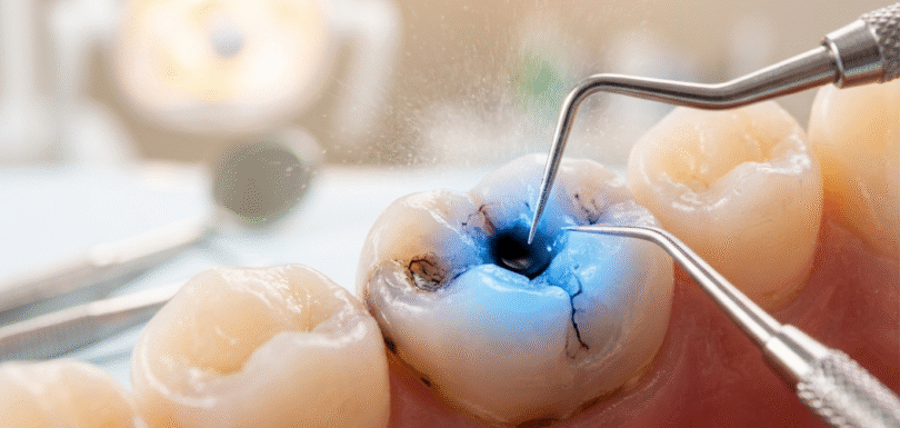 Why Does One Tooth Keep Getting Cavities?